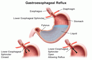 Gastroesophageal Reflux